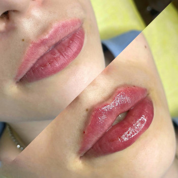 Увеличение губ
                    Косметологічний центр  Київ