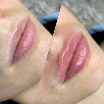 Увеличение губ
                    Косметологічний центр  Київ