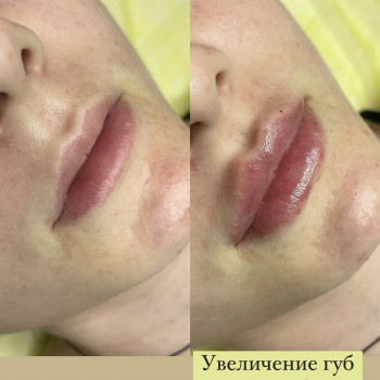 Увеличение губ
                    Косметологічний центр  Київ