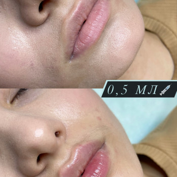 Увеличение губ
                    Косметологічний центр  Київ