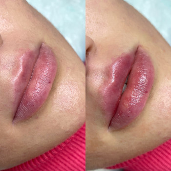 Увеличение губ
                    Косметологічний центр  Київ