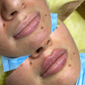 Увеличение губ
                    Косметологічний центр  Київ