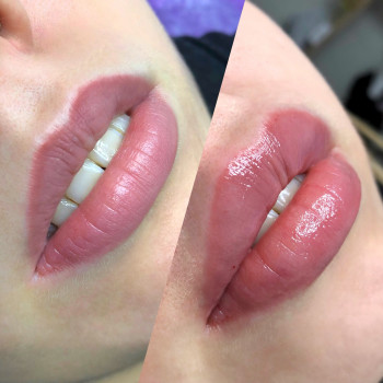 Увеличение губ
                    Косметологічний центр  Київ