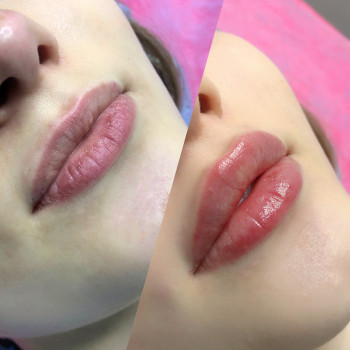 Увеличение губ
                    Косметологічний центр  Київ