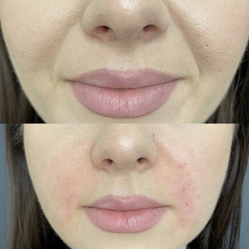 Ботокс, коррекция морщин
                    Косметологический центр  Киев