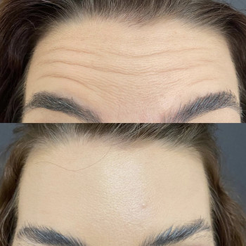 Ботокс, коррекция морщин
                    Косметологический центр  Киев