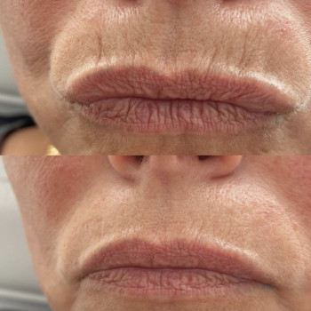 Ботокс, коррекция морщин
                    Косметологический центр  Киев