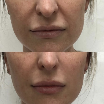 Ботокс, коррекция морщин
                    Косметологический центр  Киев