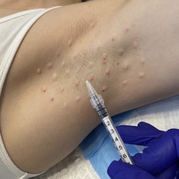 Ботокс, коррекция морщин
                    Косметологический центр  Киев