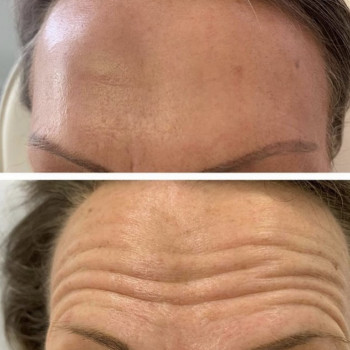 Ботокс, коррекция морщин
                    Косметологический центр  Киев