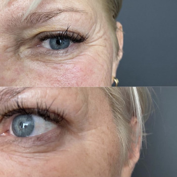 Ботокс, коррекция морщин
                    Косметологический центр  Киев