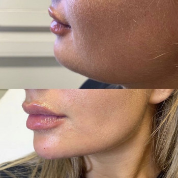 Ботокс, коррекция морщин
                    Косметологический центр  Киев