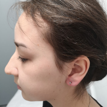 Прокол ушей (есть 4 разные системы) Inverness, XXL, Studex 75, Caflon
                    Косметолог-ін'єкціоніст Наталия Одеса