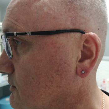 Прокол ушей (есть 4 разные системы) Inverness, XXL, Studex 75, Caflon
                    Косметолог-ін'єкціоніст Наталия Одеса