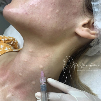 Біоревіталізація