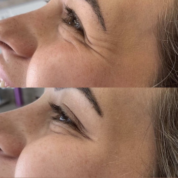 Ботокс вокруг глаз