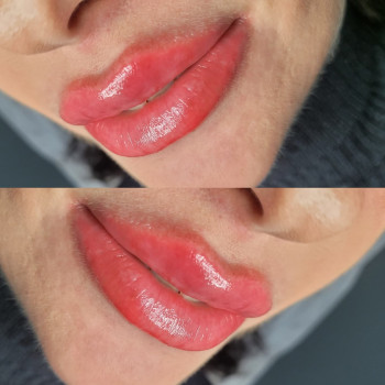 Збільшення губ
                    Салон краси MM Studio Тернопіль