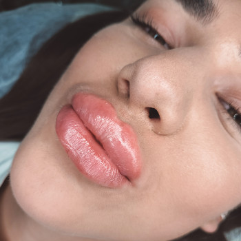 Збільшення губ
                    Салон краси MM Studio Тернопіль