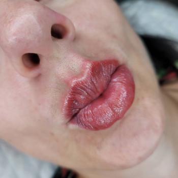 Збільшення губ
                    Салон краси MM Studio Тернопіль