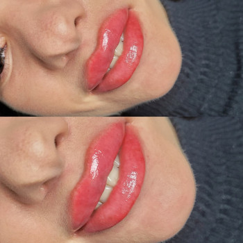 Збільшення губ
                    Салон краси MM Studio Тернопіль