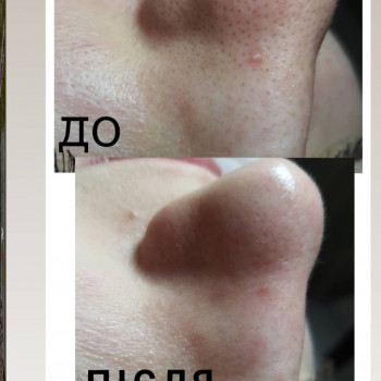 Чистка обличчя