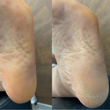 Комплексный педикюр (сложные стопы)
                    Мастер маникюра Виктория Одесса