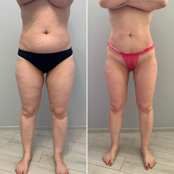 LPG- массаж
                    СПА-салон Beauty room Харьков