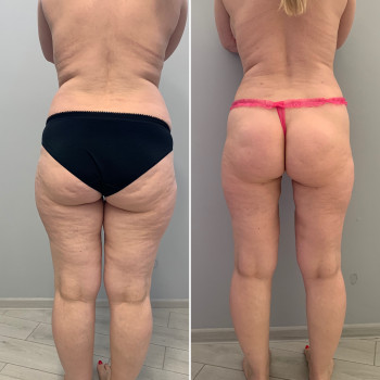 LPG- массаж
                    СПА-салон Beauty room Харьков