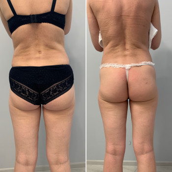 LPG- массаж
                    СПА-салон Beauty room Харьков