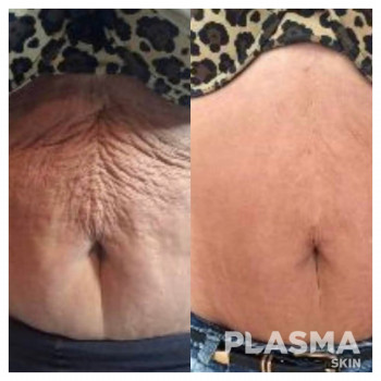 Плазменная шлифовка - одна процедура. Реабилитация 7-10 дней