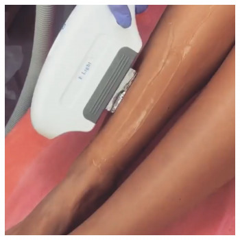 Лазерная эпиляция