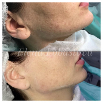 Коррекция углов нижней челюсти и увеличение подбородка