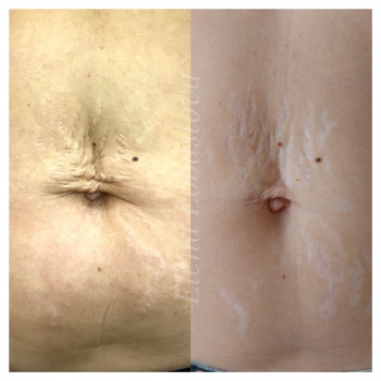 Плазменная шлифовка