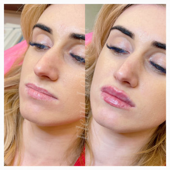 Увеличение губ ❤️