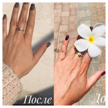 Биоревитализация рук