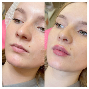 Коррекция формы губ