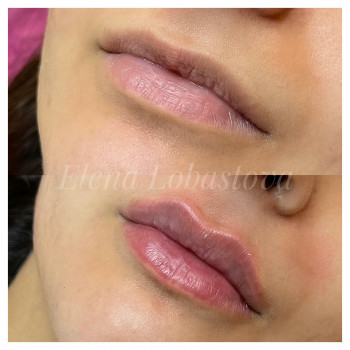 Коррекция формы и увеличение губ