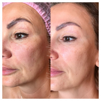 Плазменное омоложение