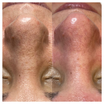 Комбинированная чистка лица