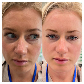 Плазменный душ
                    Косметолог Елена Харьков