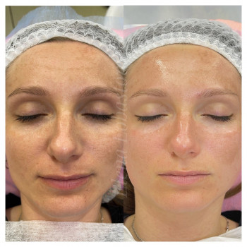 Плазменный душ
                    Косметолог Елена Харьков