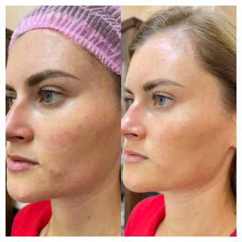 Плазменный душ
                    Косметолог Елена Харьков