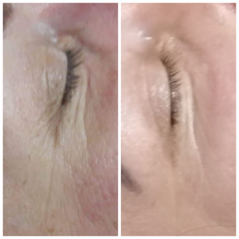 Микроплазменный термолиз
                    Косметолог Елена Харьков