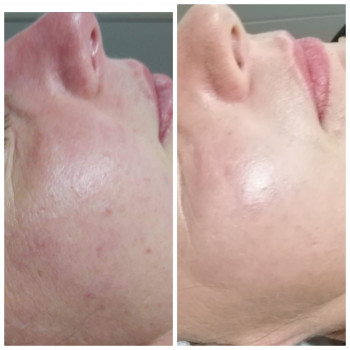 Микроплазменный термолиз
                    Косметолог Елена Харьков