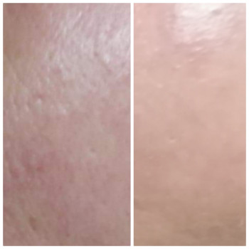 Микроплазменный термолиз
                    Косметолог Елена Харьков