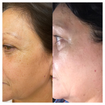 Микроплазменный термолиз
                    Косметолог Елена Харьков