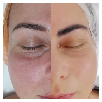 Микроплазменный термолиз
                    Косметолог Елена Харьков