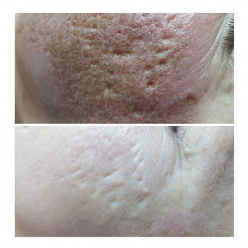 Плазменная шлифовка
                    Косметолог Елена Харків