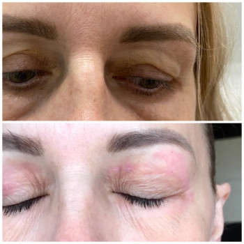 Плазменная шлифовка
                    Косметолог Елена Харків