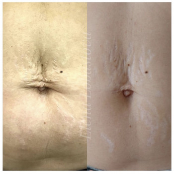 Плазменная шлифовка
                    Косметолог Елена Харків